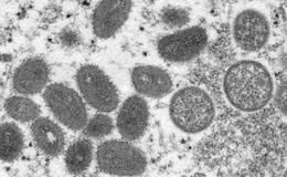 The tests taken in Iceland are sent abroad for confirmation of monkeypox.